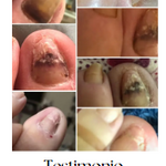 UñaSana™-¡Elimina los hongos de tus uñas de raíz! <span style="color:red;">Promoción 2x1</span>