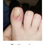 UñaSana™-¡Elimina los hongos de tus uñas de raíz! <span style="color:red;">Promoción 2x1</span>