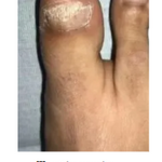 UñaSana™-¡Elimina los hongos de tus uñas de raíz! <span style="color:red;">Promoción 2x1</span>