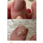 UñaSana™-¡Elimina los hongos de tus uñas de raíz! <span style="color:red;">Promoción 2x1</span>