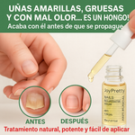 UñaSana™-¡Elimina los hongos de tus uñas de raíz! <span style="color:red;">Promoción 2x1</span>