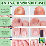 UñaSana™-¡Elimina los hongos de tus uñas de raíz! <span style="color:red;">Promoción 2x1</span>