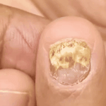 UñaSana™-¡Elimina los hongos de tus uñas de raíz! <span style="color:red;">Promoción 2x1</span>